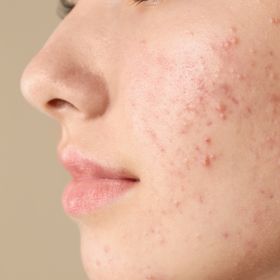 acne facials